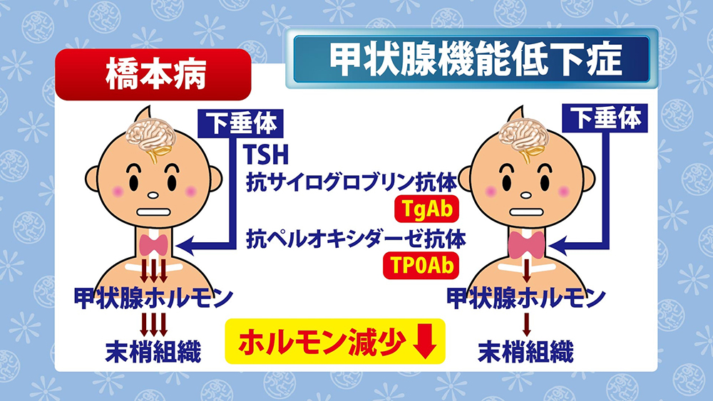  AFib は甲状腺機能低下症にどの程度よく見られますか?
